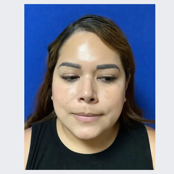 After laser treatment